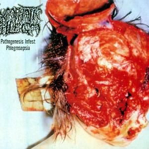 Hypothalamous Infundibulo Syndrome (Traumatic Cerebro-Vascular Accident)