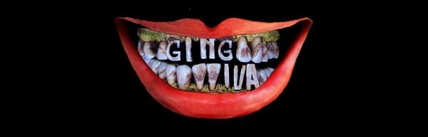 Gingiva