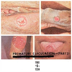 Premature Ejaculation - Part. 2