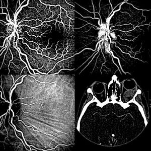 Metastases