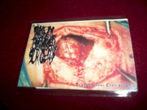 Transfrontal Craniectomy (EP)