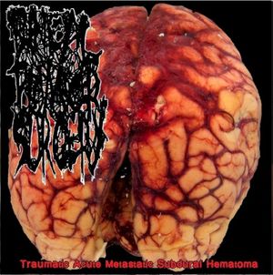 Traumatic Acute Metastatic Subdural Hematoma (EP)