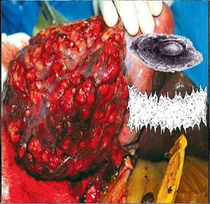 Paraganglioma / Bowel Fermentation (EP)