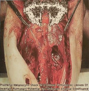 Carcinomas of Unknown Primary Origin - Stomatorrhagic Sputum