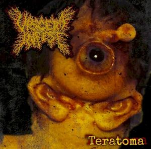 Teratoma