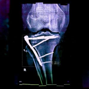 COMA (Single)